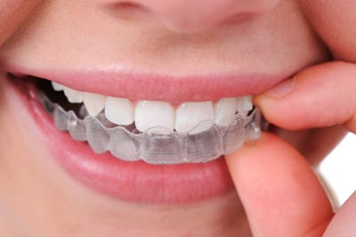 5ALIGNER